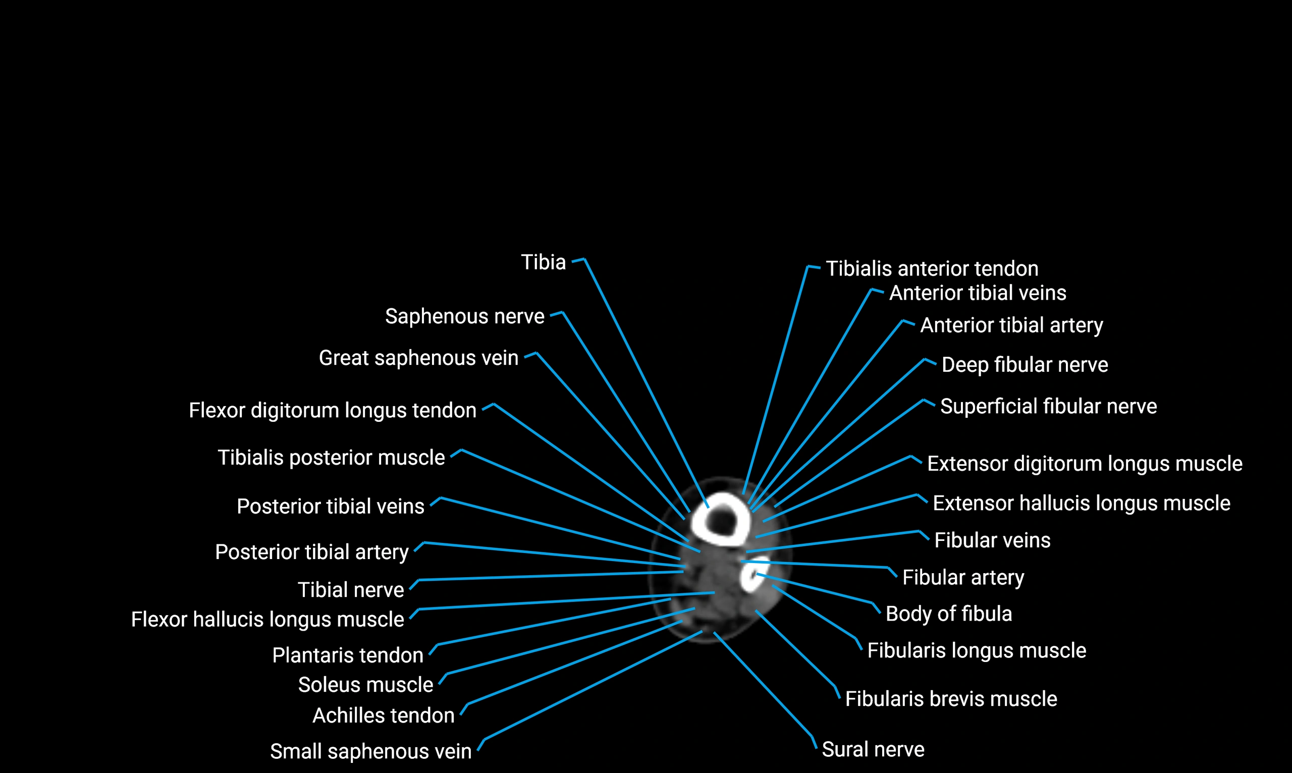 CT lower limb axial cross sectional anatomy labelled image 153 (2).webp